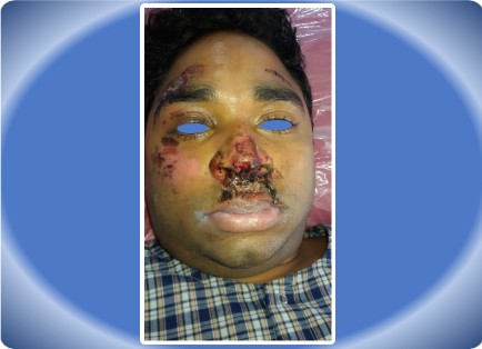 MAXILLOFACIAL INJURY